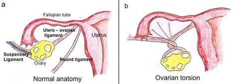 Ovarian torsion causes, symptoms, diagnosis & ovarian torsion treatment