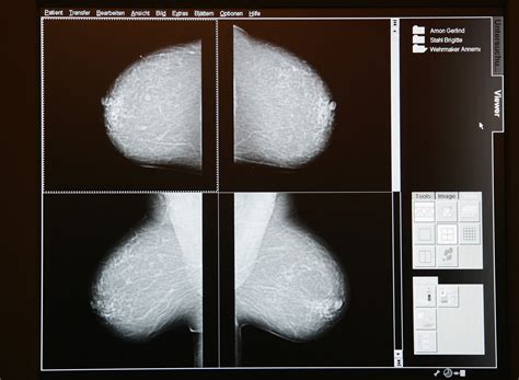 Breast Cancer Awareness Month: 'The Standard Mammogram Is Missing 50% Of Breast Cancer Diagnoses ...