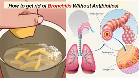 Bronchitis Prevention: How to get rid of Bronchitis Without Antibiotics!