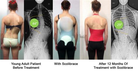 Moderate Scoliosis Treatment