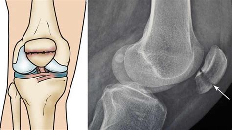 Patella fracture causes, types, symptoms, diagnosis, treatment & recovery