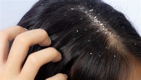 Anti-Dandruff Treatment for Scalp - Dr. Praneeth Clinic