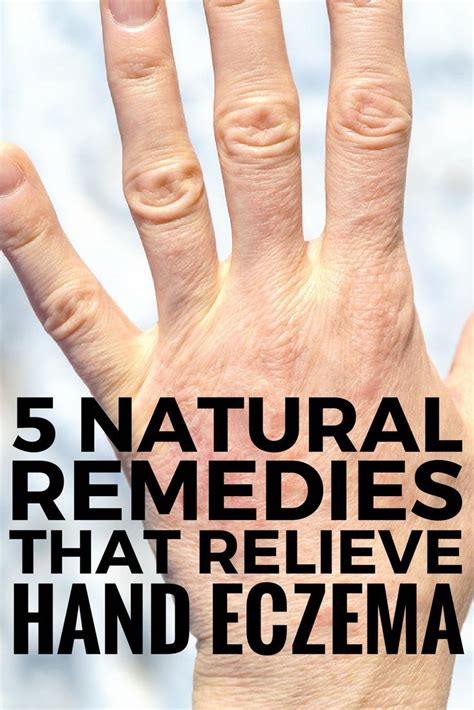 5 Natural Hand Eczema Remedies that Work! There are different types of ...