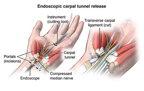 Carpal Tunnel Release - Health Encyclopedia - University of Rochester ...