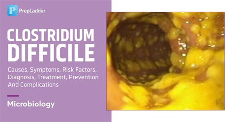 Clostridium Difficile: Causes, Symptoms, Risk Factors, Diagnosis, Treatment, Prevention and ...