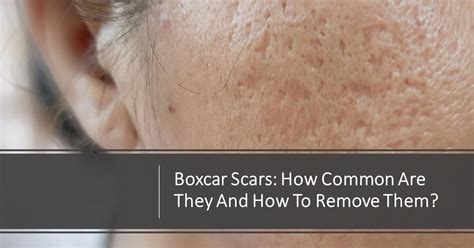 Boxcar Scars: How Common Are They and How to Remove Them? | Dream ...