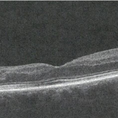 oCt scan of the macula showing loss of retinal pigment epithelium 14 ...