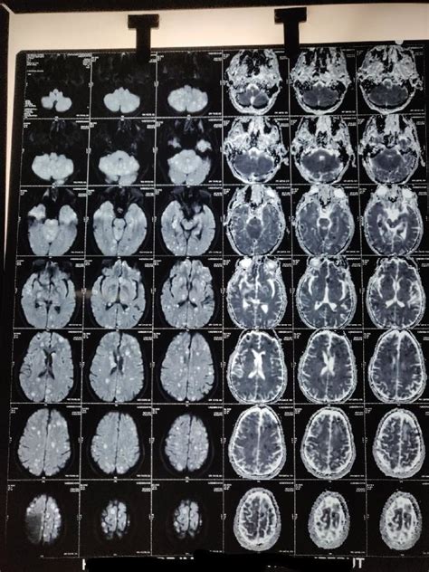 Neurocysticercosis treatment 2020