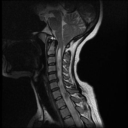 Chiari I malformation and extensive cervico-thoracic syringohydromyelia | Radiology Case ...