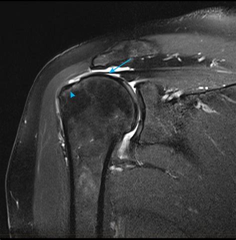 Supraspinatus Tendon Complete Tear | Images and Photos finder