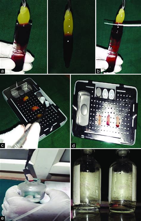 Preparation of modified (advanced platelet-rich fibrin) membrane: (a)... | Download Scientific ...