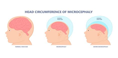 What Is Microcephaly? What You Need To Know | BellyBelly