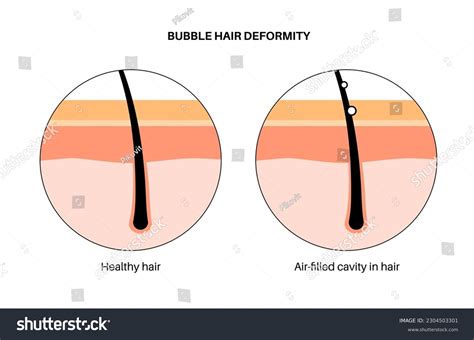 Bubble hair deformity. Head disease, normal and - Royalty Free Stock Vector 2304503301 - Avopix.com