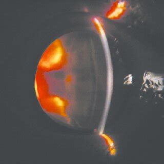 On slit-lamp examination findings show circumcorneal congestion,... | Download Scientific Diagram