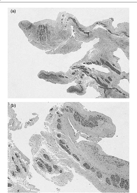 Figure 2 from Papillary fibroelastoma of the right atrium as an unusual source of recurrent ...