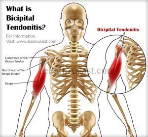 Bicipital tendonitis : Physiotherapist Tralee - Eddie O'Grady Physiotherapist