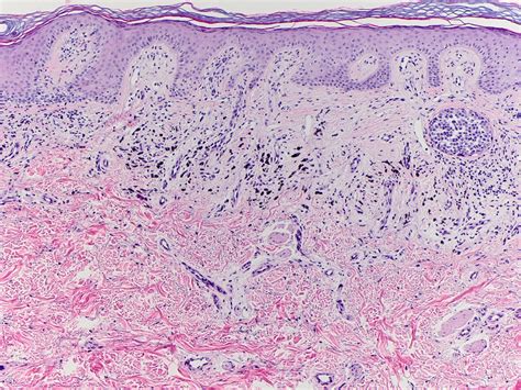 C Gluteal cleft lesion - dermpath