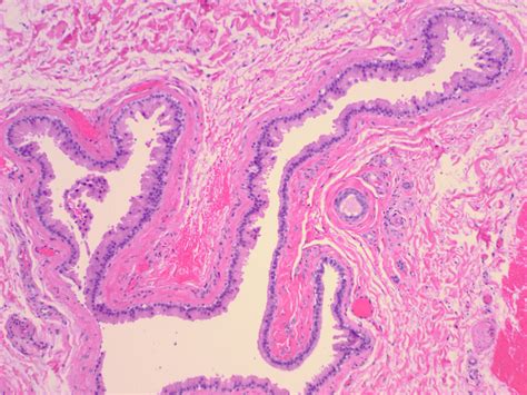 Apocrine hidrocystoma =الكيسوم العرقي المفترز