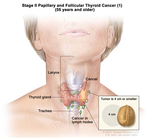 [Table], Table 3. Definitions of Differentiated TNM Stage II for Papillary and Follicular ...