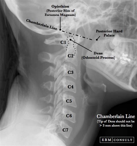 Chamberlain Line on Radiographic Image