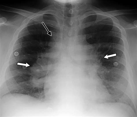 Sarcoidosis from Head to Toe: What the Radiologist Needs to Know ...