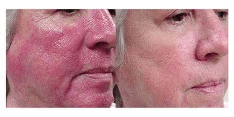 Rosacea Laser Treatment in Surrey | Rhinophyma & Vascular Lesions