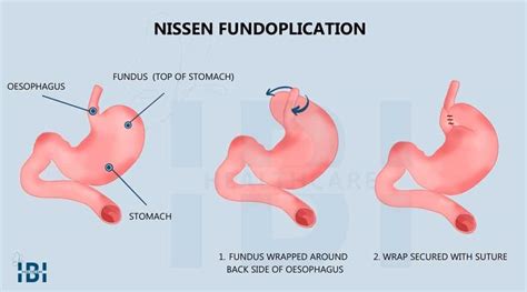 Nissen Fundoplication Weight Loss | Blog Dandk