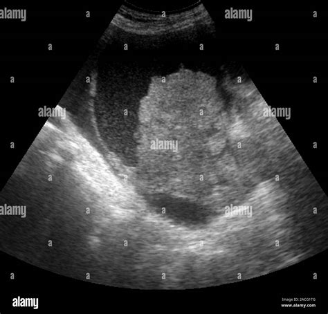 Foetal ascites. Ultrasound scan of a foetus with ascites, a condition ...