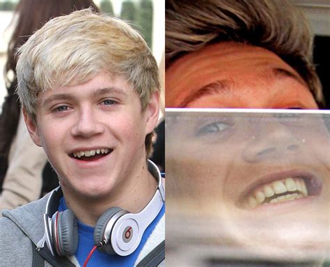 Niall Horan Smile Before After