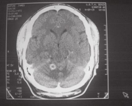 Computerized brain scan showing a ring enhancing lesion in the right... | Download Scientific ...