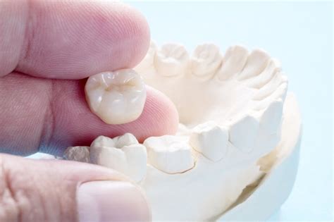 Different Types of Dental Crowns | A&R Advanced Dental