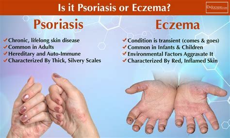 What is the Difference Between Psoriasis and Eczema? #PsoriasisHair | Psoriasis remedies ...