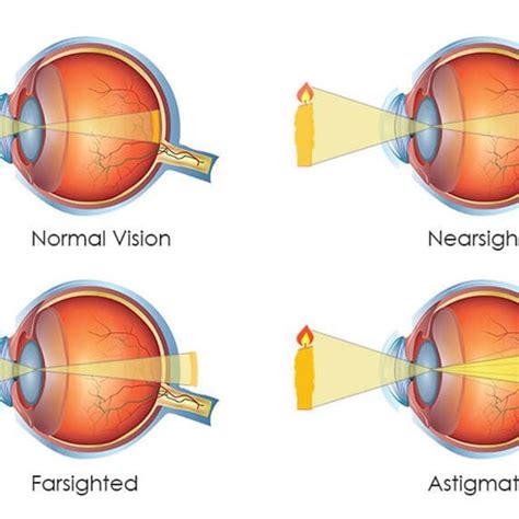 Long-sightedness and short-sightedness are two common vision problems so glasses must be ...