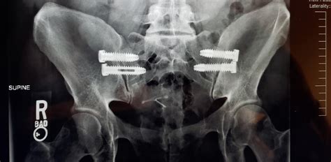 Bilateral sacroiliac joint fusion surgery : r/XRayPorn