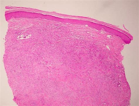 Erythema Elevatum Diutinum - Bako Diagnostics