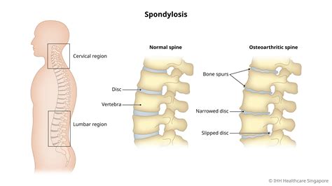 Cervical & Lumbar Spondylosis - Symptoms & Causes | Parkway Shenton