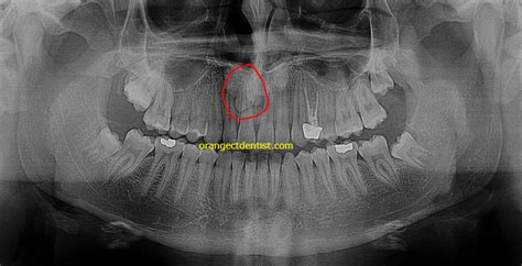 Mesiodens | Supernumerary Teeth | Calcaterra Family Dentistry, Orange CT