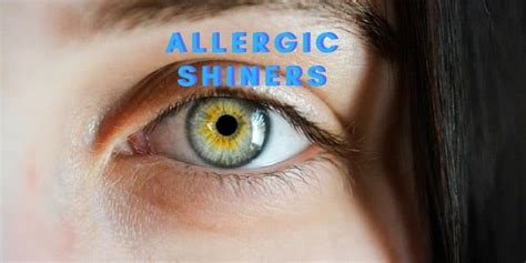 do allergic shiners go away | Allergic, Shiner, Going away