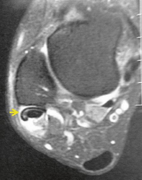 1 MRI showing peroneus brevis tendinopathy ( yellow arrow ). Notice fl... | Download Scientific ...