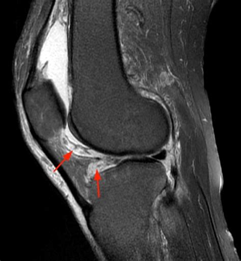 Rheumatoid Arthritis Knee Mri