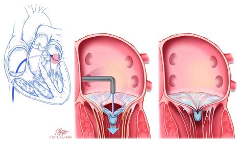 Mitral Valve Repair Medmonks Mitral Valve Mitral Valve Repair | Images ...