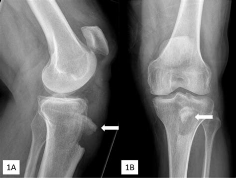 Cureus | Combined Tibial Tubercle Fracture With Patellar Tendon Avulsion in an Adult: A Rare ...