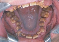 Congenital enamel hypoplasia | definition of Congenital enamel hypoplasia by Medical dictionary