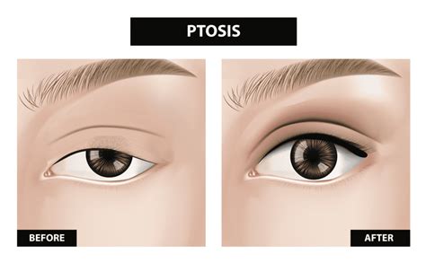 What Causes Ptosis, and How Is It Corrected?: Rand Rodgers, MD ...