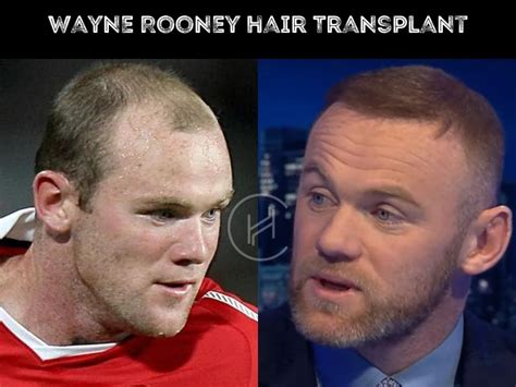 Wayne Rooney Hair Transplant - Hair Loss & Technical Analysis