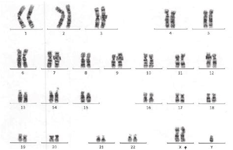 Cytogenetic analysis showing an extra X chromosome. | Download ...