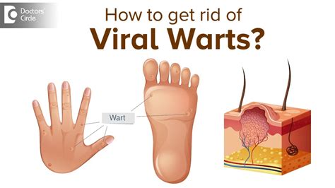 What are Viral Warts and what do we need to know about it? - Dr. Divya Sharma|Doctors' Circle ...