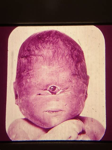 MEDICAL ODDITIES RARE ORIGINAL PHOTO FILM SLIDE CYCLOPIA BIRTH DEFECT ONE EYE | eBay