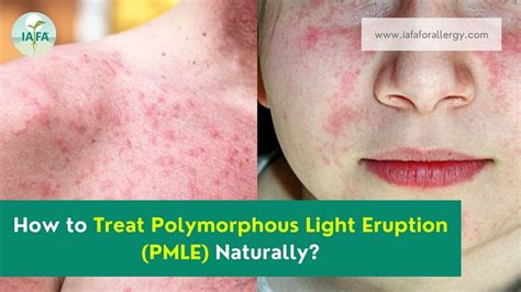 How to Treat Polymorphous Light Eruption (PMLE) Naturally?