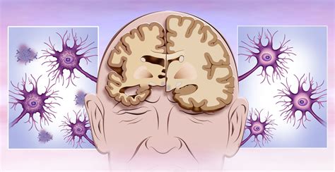 Stroke, Brain Injury, and Dementia: is there a link?